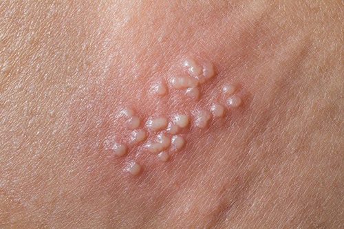 ✲Địa chỉ chữa mụn rộp sinh dục uy tín tin cậy tại Vĩnh Long