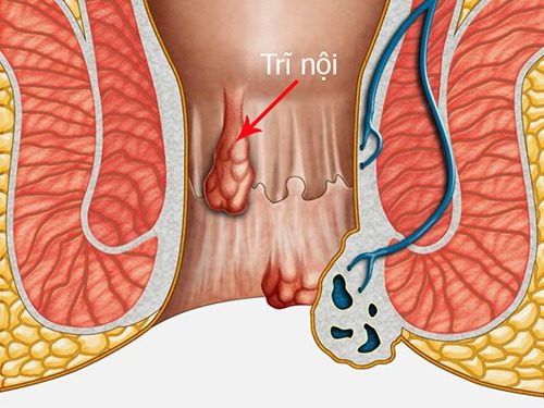 #Địa chỉ chữa bệnh trĩ nội uy tín tại An Giang - Phòng Khám Nam Khoa An Giang