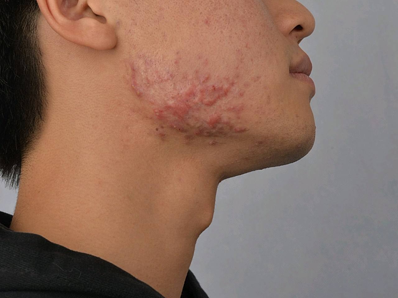 Hiện tượng mụn trứng cá ở tuổi dậy thì và cách điều trị phù hợp