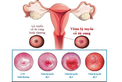 #Địa chỉ chữa viêm lộ tuyến cổ tử cung uy tín tại Tiền Giang - Phòng Khám Nam Khoa An Giang