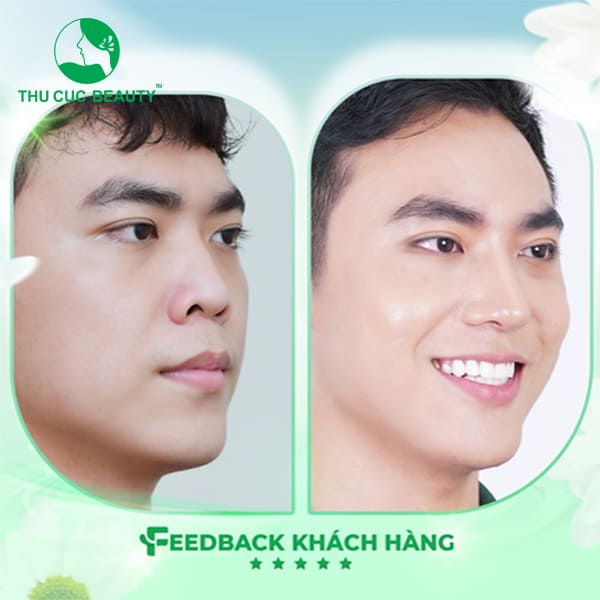 Nâng mũi nam - Làm đẹp mũi cho nam giới - Thu Cúc Sài Gòn