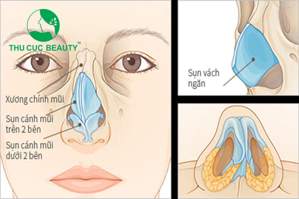 Nâng mũi sụn vách ngăn - Thu Cúc Sài Gòn