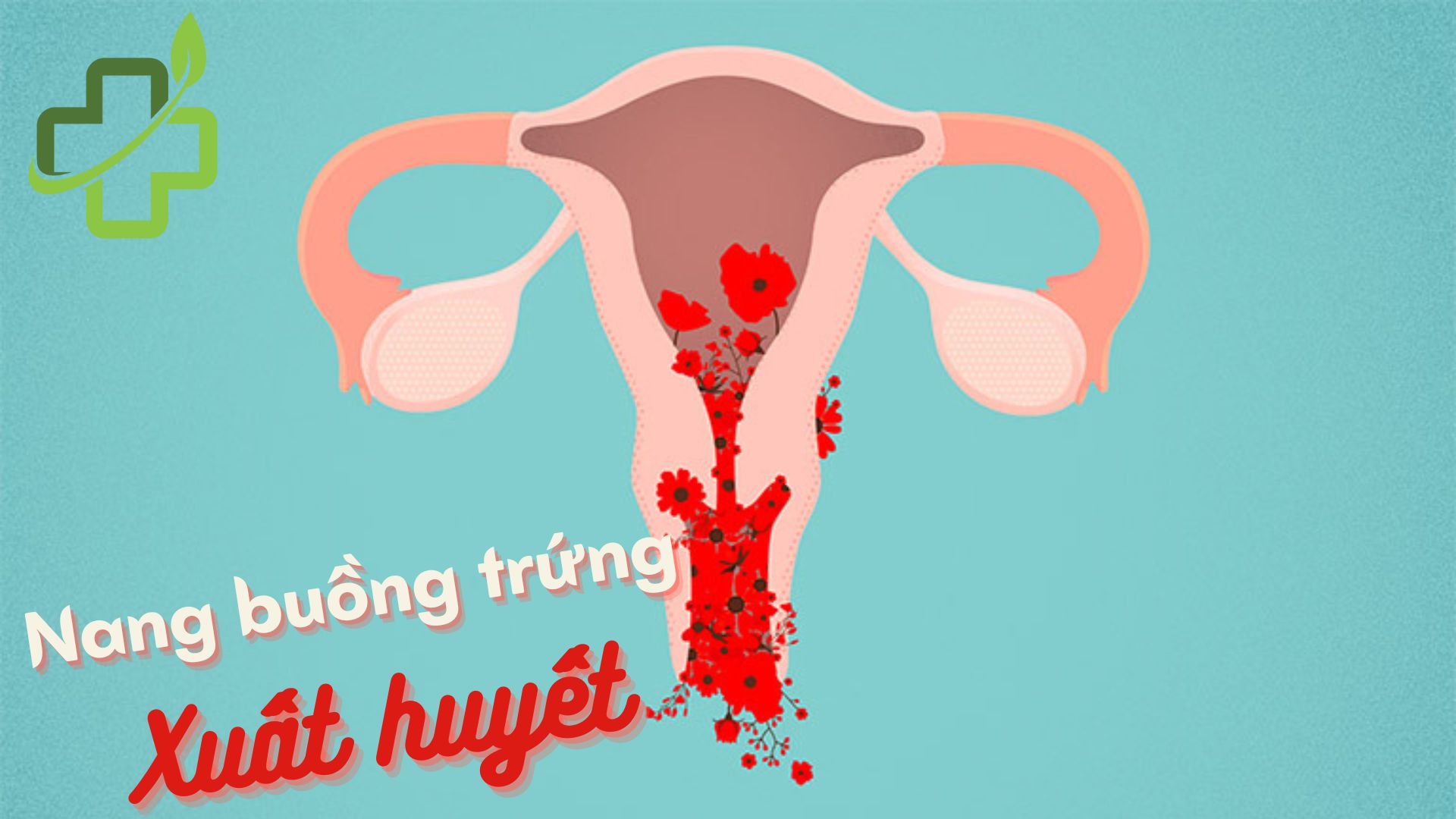 [Nang buồng trứng xuất huyết] Nguyên nhân, triệu chứng và cách điều trị 