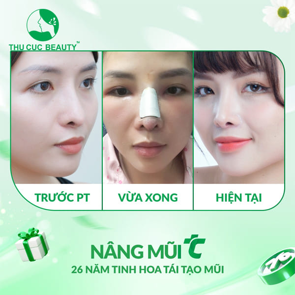 Có nên nên nâng mũi không? - Thu Cúc Sài Gòn