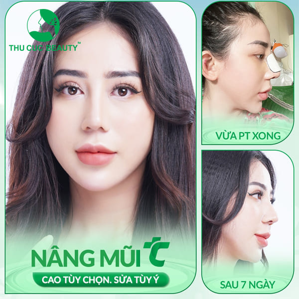 Nâng mũi có để được cả đời không? - Thu Cúc Sài Gòn