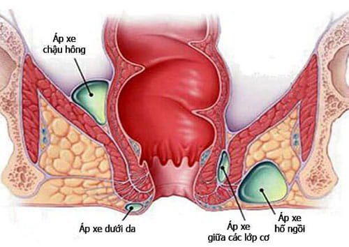 #Địa chỉ chữa bệnh áp xe hậu môn uy tín tại Tiền Giang - Phòng Khám Nam Khoa An Giang