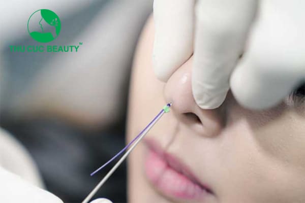 Nâng mũi chỉ collagen - Thu Cúc Sài Gòn