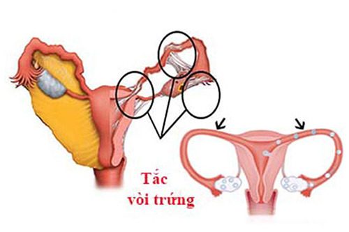 #Địa chỉ thông tắc vòi trứng uy tín an toàn tại An Giang - Phòng Khám Nam Khoa An Giang