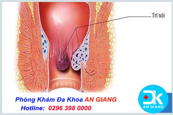 Hậu môn nổi mụn thịt là bị bệnh gì? cách chữa trị - Phòng Khám Nam Khoa An Giang