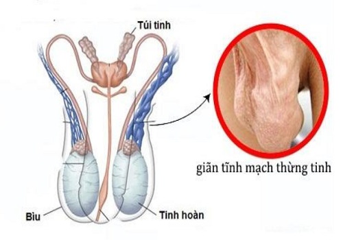 Tác hại/ hậu quả của giãn tĩnh mạch thừng tinh ở nam giới - Phòng Khám Đa Khoa An Giang
