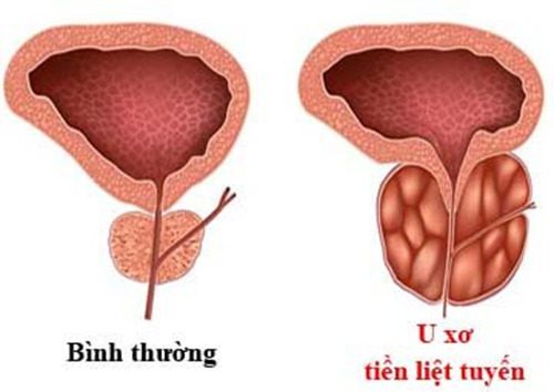 #Địa chỉ chữa u xơ tuyến tiền liệt uy tín tại Tiền Giang - Phòng Khám Nam Khoa An Giang