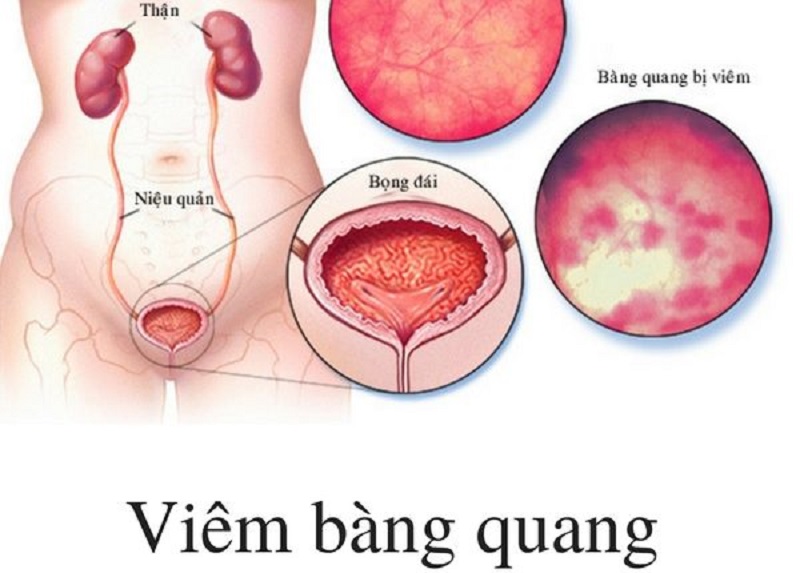 Viêm bàng quang biến chứng có nguy hiểm gì? Cách điều trị và chăm sóc