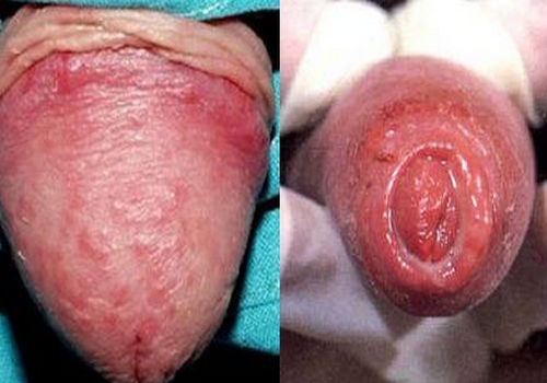 Phòng tránh tác hại tình trạng sưng ngứa bao quy đầu | Phòng Khám Đa Khoa An Giang