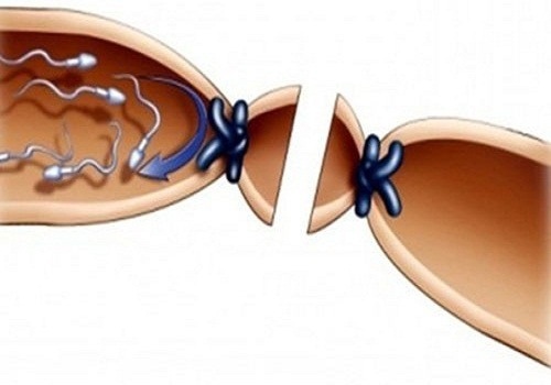 Nguyên nhân tắc ống dẫn tinh – nam giới biết để đề phòng - Phòng Khám Đa Khoa An Giang