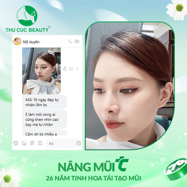 Nâng mũi sau 10 ngày mũi đã đẹp chưa? - Thu Cúc Sài Gòn