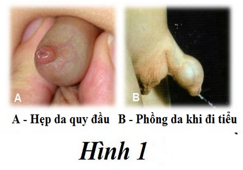 Hẹp bao quy đầu và dấu hiệu đặc trưng của bệnh | Phòng Khám Đa Khoa An Giang