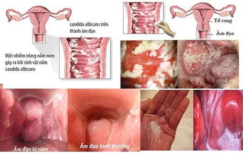 #Địa chỉ chữa viêm âm đạo uy tín tại Tiền Giang - Phòng Khám Nam Khoa An Giang