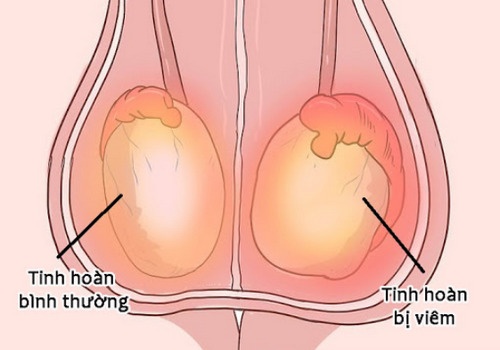 Tinh hoàn bị sưng đau là bệnh gì? Cách chữa trị an toàn hiệu quả - Phòng Khám Đa Khoa An Giang