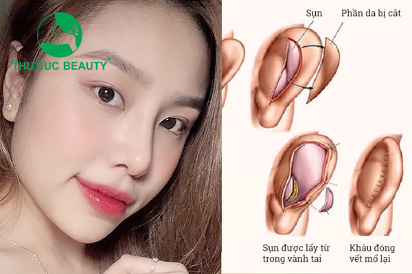 Nâng mũi sụn tai - Thu Cúc Sài Gòn