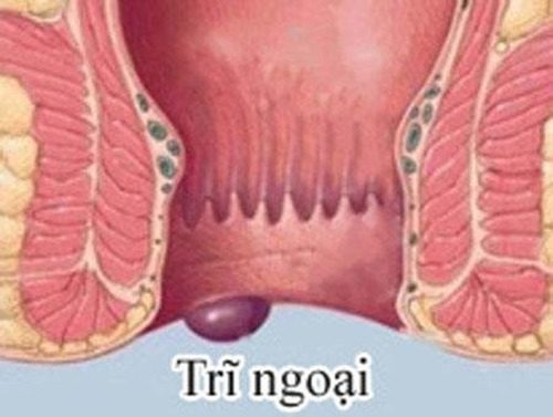 #Địa chỉ chữa bệnh trĩ ngoại uy tín tại Tiền Giang - Phòng Khám Nam Khoa An Giang