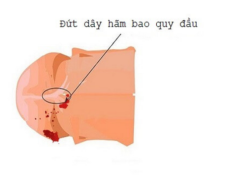 Bao quy đầu bị rách có làm sao không, xử lý như thế nào | Phòng Khám Đa Khoa An Giang
