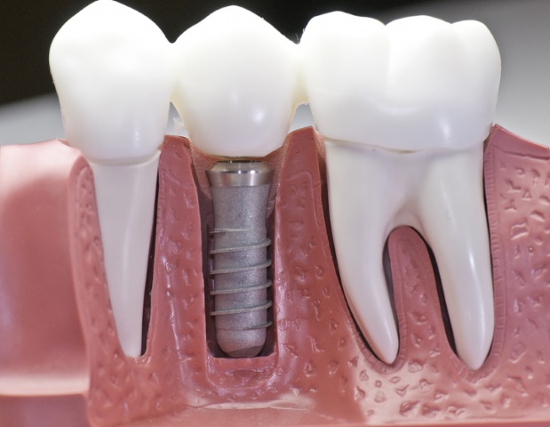 Factors That Affect the Success of Dental Implants