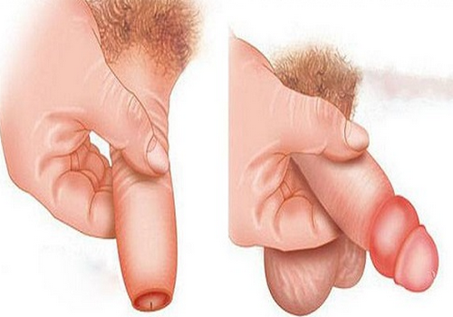Địa chỉ thăm khám và điều trị sưng bao quy đầu tiết kiệm chi phí | Phòng Khám Đa Khoa An Giang