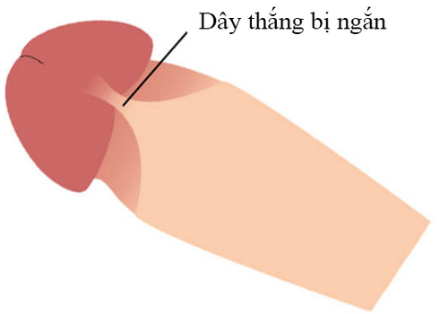 Đứt dây hãm: Nguyên nhân, dấu hiệu và cách chữa trị  | Phòng Khám Đa Khoa An Giang