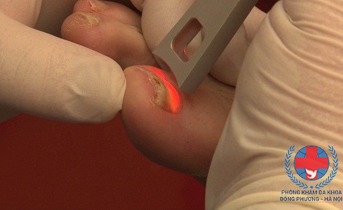 Trị nấm móng bằng laser là phương pháp như thế nào?