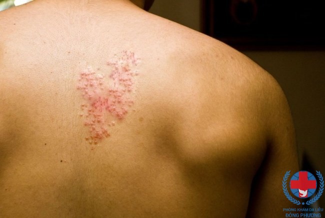 2 bước xác định bệnh zona thần kinh chuẩn xác nhất!