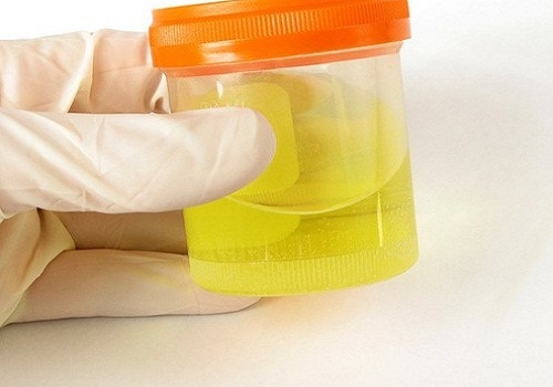 Chẩn đoán bệnh lý qua màu nước tiểu – không nên bỏ qua