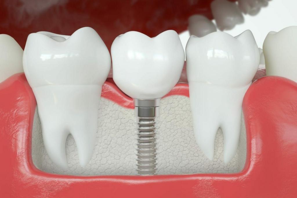 Why Cost Of Dental Implants Differ So Much? » YouNet Company