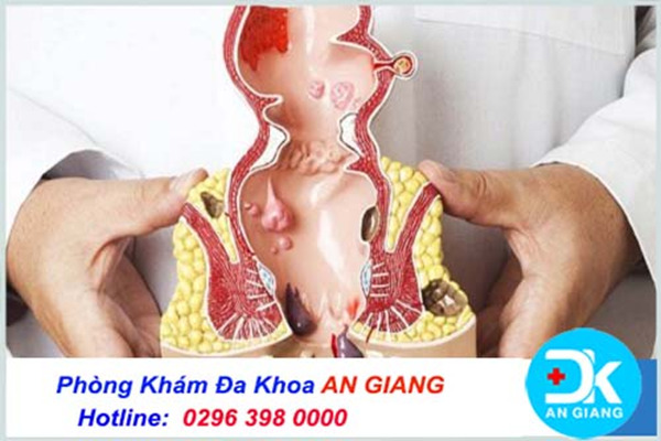 Địa chỉ chữa bệnh trĩ uy tín tại Bạc Liêu