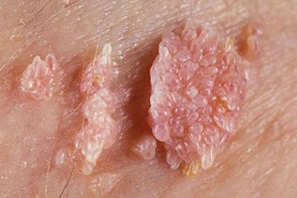 Địa chỉ chữa bệnh sùi mào gà uy tín tại An Giang