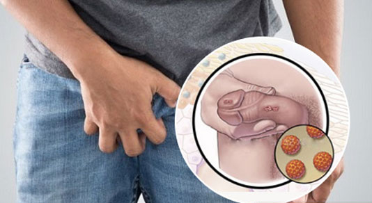 Mụn nước ở dương vật là bệnh gì? Địa chỉ chữa bệnh uy tín tại Hà Nội