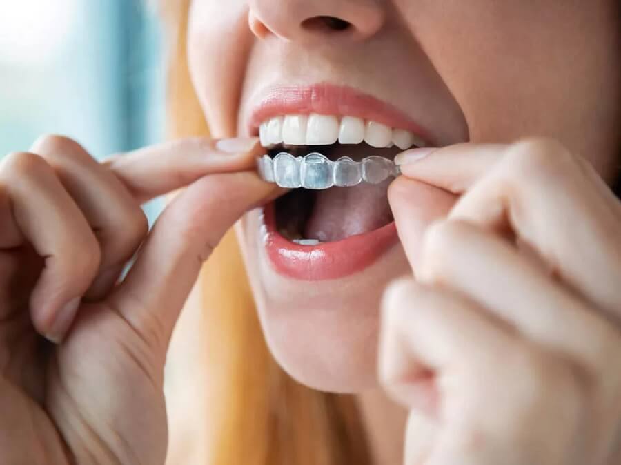 How Does Invisalign Crawfordville FL Work?