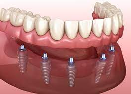 7 Advantages of an Implant Denture » YouNet Company