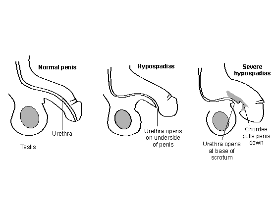 Penile surgery in baby boys for chordee, hypospadias, and penile torsion
