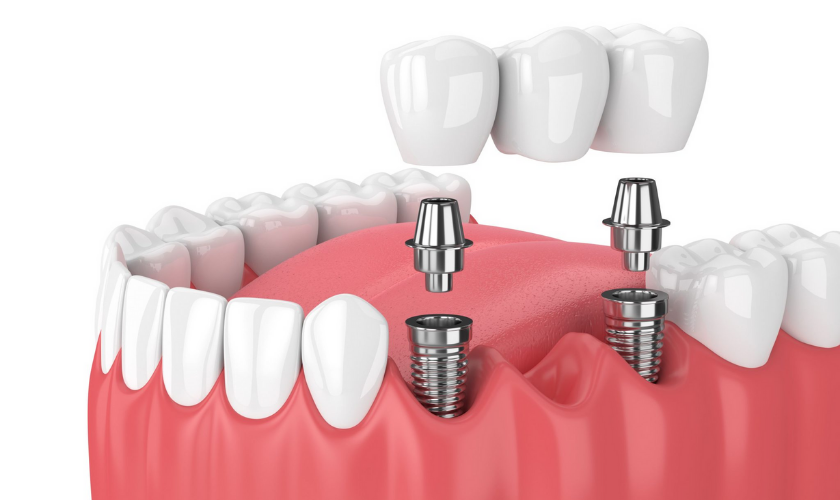 6 Reasons Why You Should Choose Dental Implants For Your Dental Care » YouNet Company
