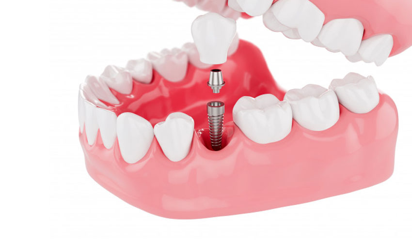 Why There Is Different Cost of Dental Implants? » YouNet Company
