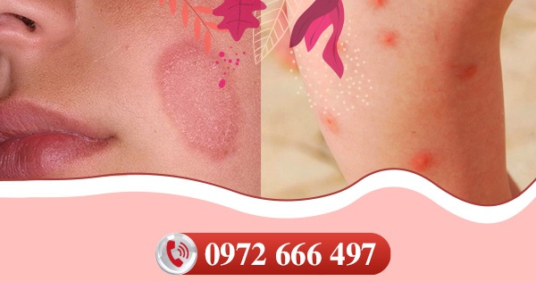 Ghẻ lở - Hắc lào là bệnh gì?