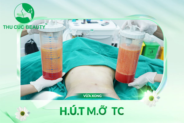 Hút mỡ - Mang tới vóc dáng thon gọn, cân đối
