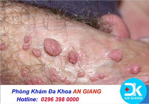 Mọc mụn ở dương vật có nguy hiểm không?