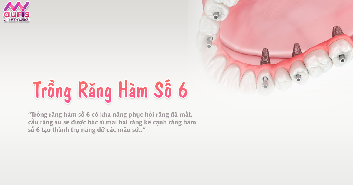 Tại sao phải thực hiện trồng răng hàm số 6? - Nha Khoa My Auris