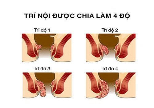 Các giai đoạn của bệnh trĩ nội kéo dài trong thời gian bao lâu