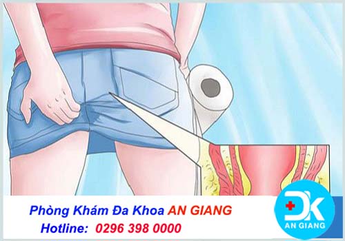 Đau nhức hậu môn là dấu hiệu của bệnh gì?