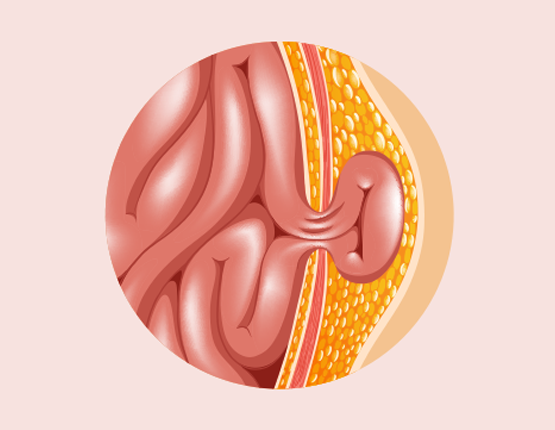 Looking for the hernia surgery cost in Pakistan? We make it affordable
