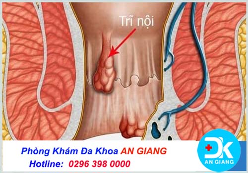 Bệnh trĩ nội: Nguyên nhân, triệu chứng và cách chữa trị hiệu quả