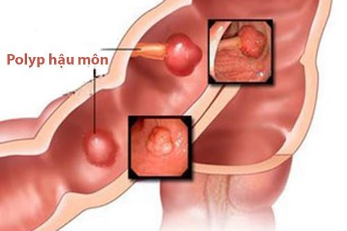 Polyp hậu môn: Nguyên nhân, triệu chứng và cách chữa trị