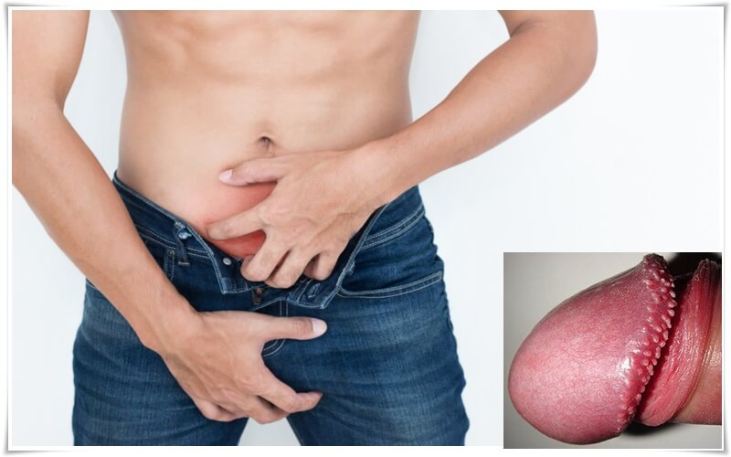 Chuỗi hạt ngọc dương vật và cách chữa trị dứt điểm khỏi hẳn